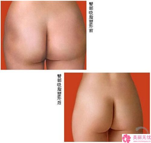 青島市自體脂肪顆粒注射填充移植豐臀術(shù)公布2022價(jià)目表-2022年12月14日自體脂肪顆粒注射填充移植豐臀術(shù)均價(jià)為：32656元