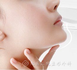 玻尿酸墊下巴