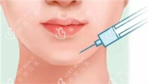 玻尿酸豐下巴的示意圖