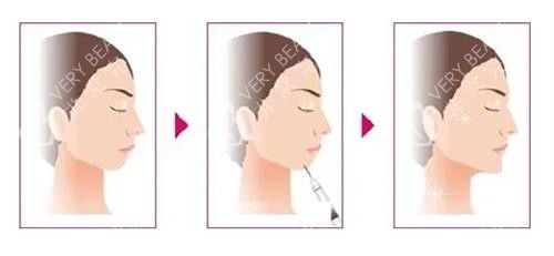 玻尿酸豐下巴前后的區(qū)別