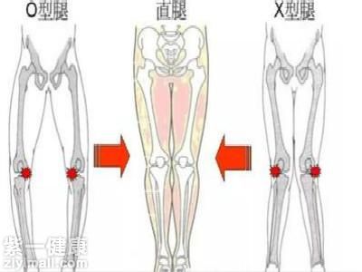怎么快速矯正o型腿 三招教你擁有模特美腿