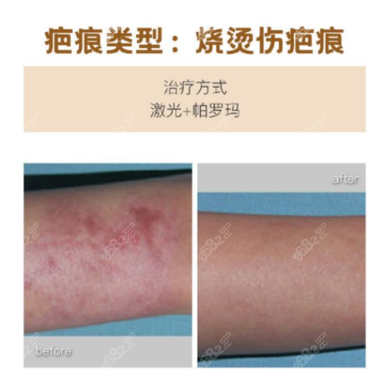 九院做激光脫毛的價格多少 九院做激光脫毛的價格多少錢