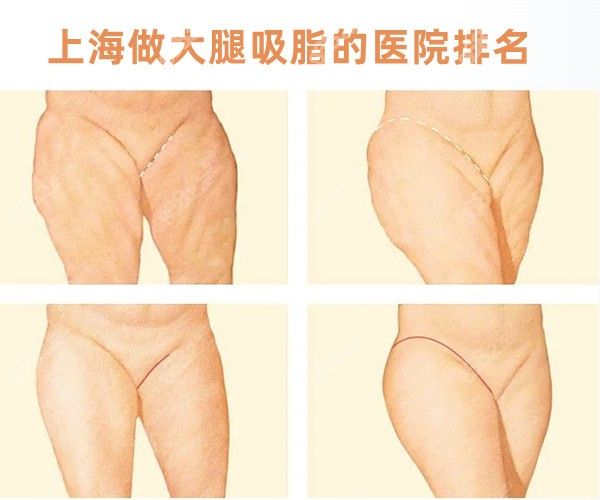 上海做大腿吸脂的医院排名