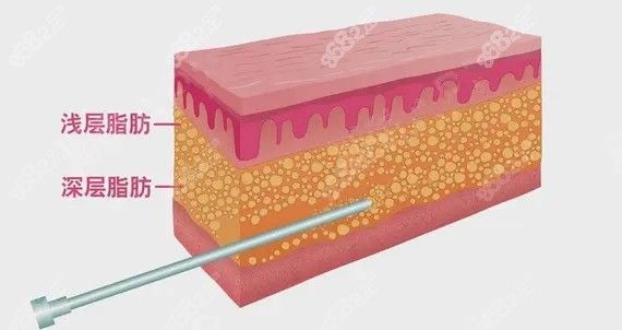 上海華美大腿分層吸脂