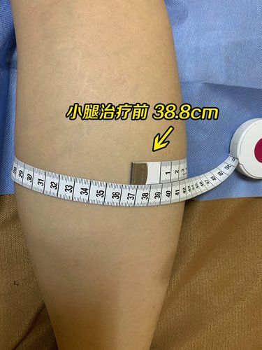 隔空溶脂瘦小腿體驗(yàn)11天后效果，真實(shí)感受！