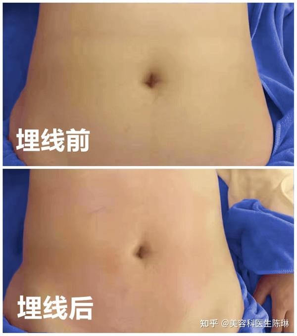 埋線減肥一定要做3次_埋線減肥得埋幾次_埋線減肥一定要做次