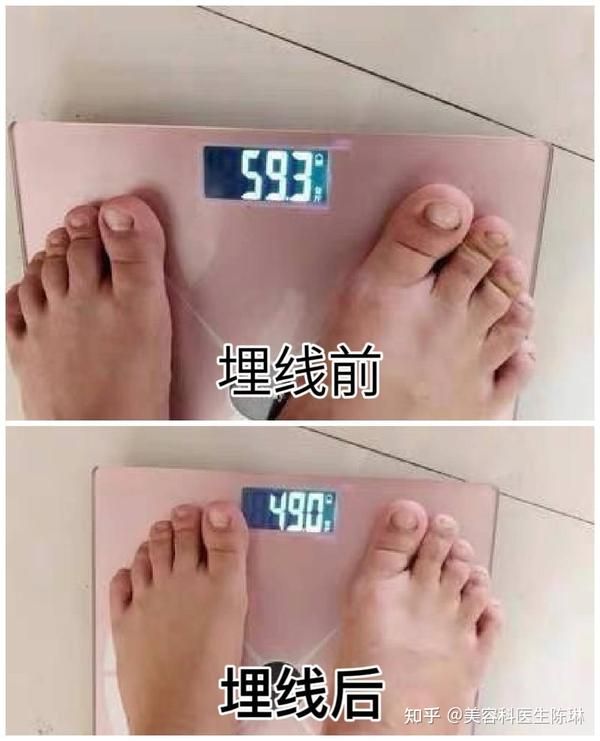 埋線減肥一定要做3次_埋線減肥得埋幾次_埋線減肥一定要做次