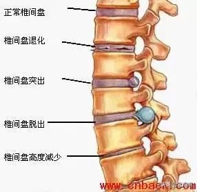 日常緩解腰痛方法——核心肌群的鍛煉