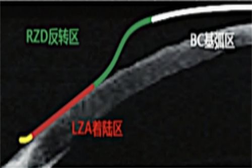 CRT角膜塑形鏡作用示意圖