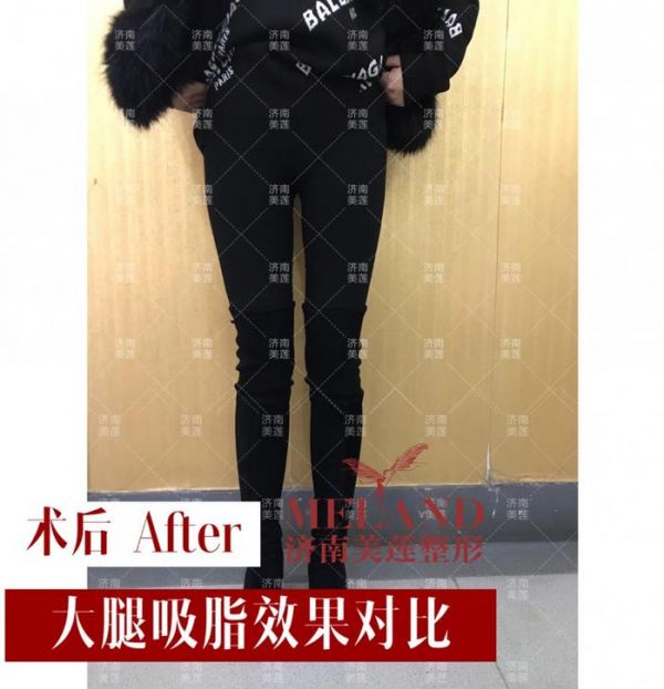可怕！減肥沒那么簡單，節(jié)食和運(yùn)動都可能引發(fā)大病！