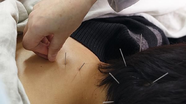 腹部針灸減肥 不再承受節(jié)食痛苦