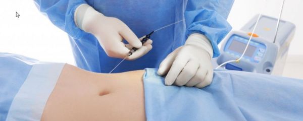 吸脂減肥有效嗎 吸脂減肥會(huì)不會(huì)引起并發(fā)癥 哪些人不適合做吸脂手術(shù)