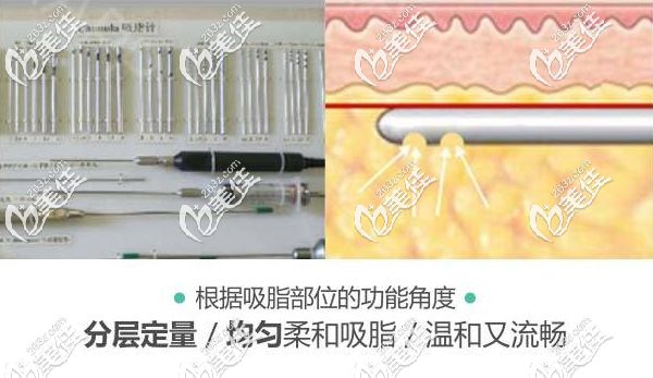 軍大魔力塑吸脂采用德國(guó)軍工定制吸脂針