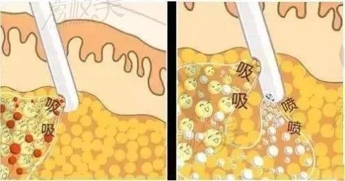 杭州美萊整形醫(yī)院吸脂價(jià)格表 