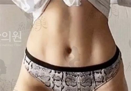 抽脂費(fèi)用抽脂價(jià)格一覽表
