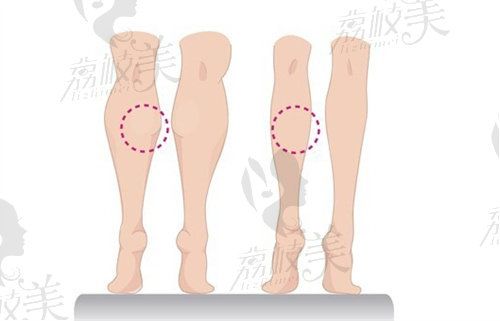 抽脂費(fèi)用抽脂價(jià)格一覽表