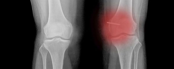 每日喝多少水才是最合适的 引起腰疼的原因有哪些 腰疼如何缓解