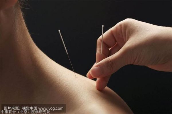 針灸減肥法：一種安全有效的瘦身方式(1)