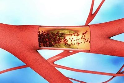 颈动脉斑块十分危险！应该怎样预防？