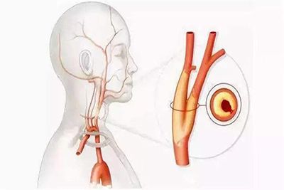 颈动脉斑块十分危险！应该怎样预防？