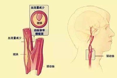 哪些人更易出現(xiàn)頸動(dòng)脈斑塊？怎樣改善預(yù)防？