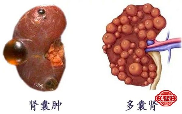 腎囊腫16.jpg