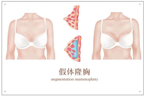 重慶華美陳德法要點(diǎn)名費(fèi)1w起，隆胸收費(fèi)詳情也有技術(shù)超值