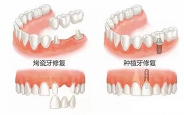湖南懷化口腔價(jià)格表2025，含鑲牙種牙補(bǔ)牙拔牙矯正根管治療