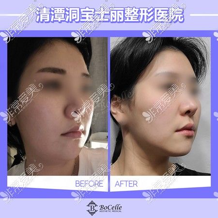 韩国清潭洞宝士丽整形医院脸部抽脂对比照片真实