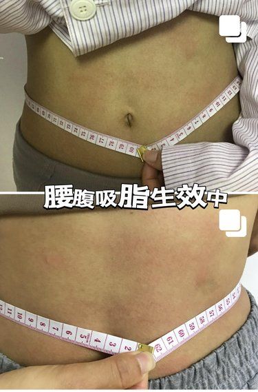 腰腹吸脂一年，大數據推給想吸脂的姐妹