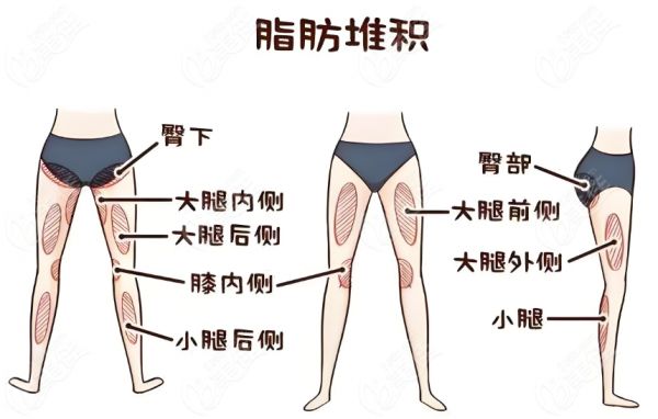 大腿抽脂8個(gè)部位圖