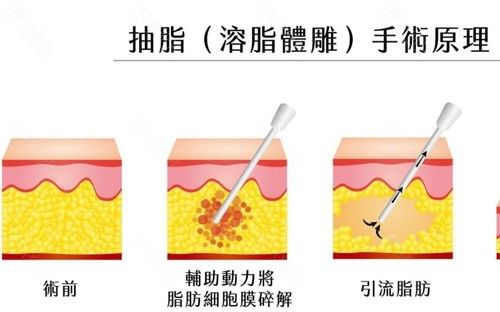 抽脂減肥一般要多少錢