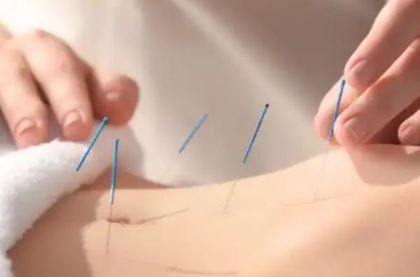 針灸減肥的副作用(針灸減肥的要點)