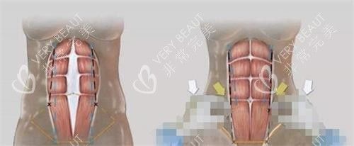 美人魚腹壁成形術(shù)的過程