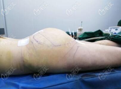 媽媽臀做抽脂術(shù)后即刻效果照