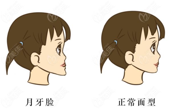 下颌骨矫正