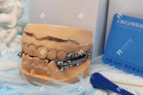 Herbest矫正下颌后缩价格贵吗