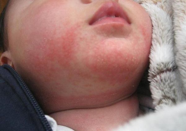 对牛奶或鸡蛋过敏可以吃益生菌吗？