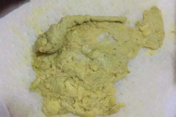 白色油脂狀大便圖