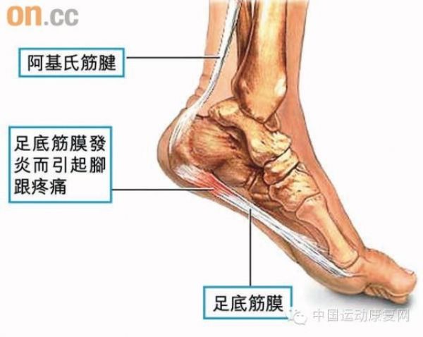 足底筋膜炎運(yùn)動(dòng)康復(fù)方法