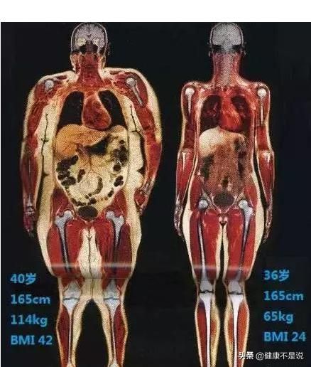 你肚子肥肉多吗，不用运动就可以清除内脏脂肪