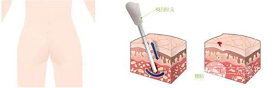 背部吸脂減肥價(jià)格