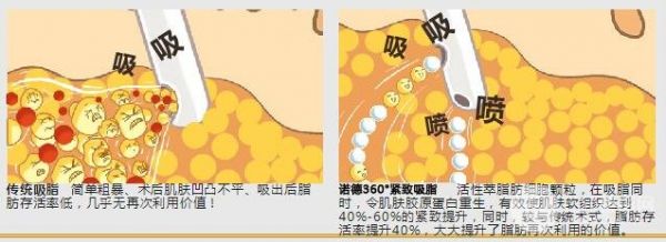 背部吸脂減肥價(jià)格