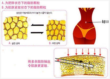 背部吸脂減肥價(jià)格