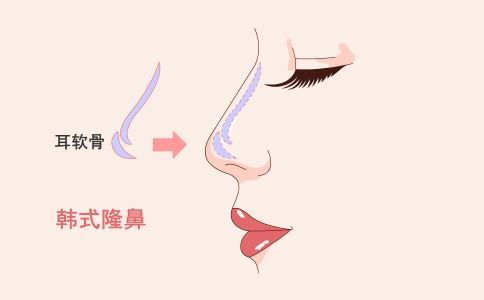 什么是背部吸脂 背部吸脂是什么 背部吸脂后如何護(hù)理