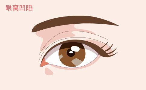 背部吸脂的費(fèi)用是多少 背部吸脂適合哪些人 背部吸脂能吸很厚的脂肪嗎