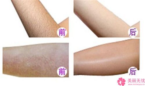 长沙市哪个美容医院吸脂手术背部好(长沙市吸脂手术背部医院在榜名单强榜前10名效果盘点)