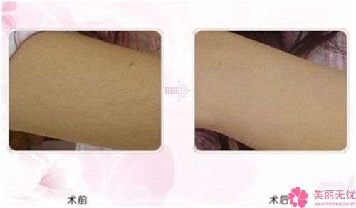 宁德王大夫美容整形医院背部植皮手术价格是多少钱啊