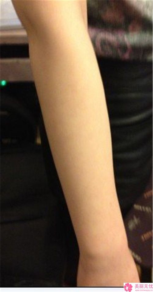 背部做吸脂瘦背对身体的伤害有多大