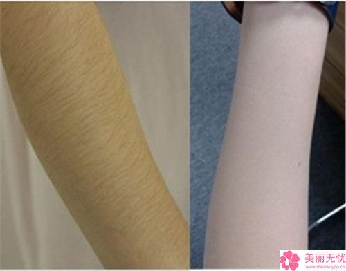 背部做吸脂瘦背对身体的伤害有多大